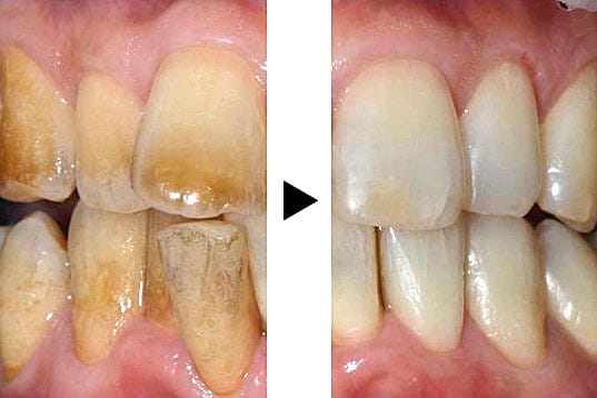 歯の変色を除去するエアフロー